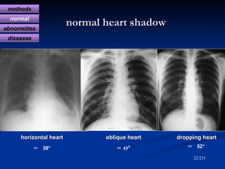 normal heart shadow /231 ＝ 45 ° oblique heart horizontal heart dropping heart ＝  38° ＝  52° methods normal abnormities dis...