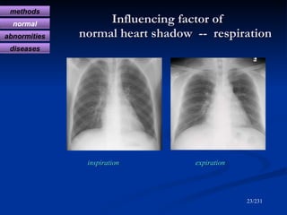 Influencing factor of    normal heart shadow  --  respiration <ul><li>inspiration  expiration </li></ul>/231 methods norma...
