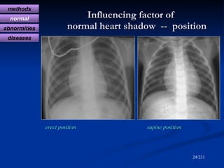 Influencing factor of    normal heart shadow  --  position <ul><li>erect position  supine position </li></ul>/231 methods ...