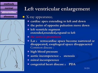 Left ventricular enlargement <ul><li>X-ray appearance ; </li></ul><ul><ul><li>cardiac apex extending to left and down </li...