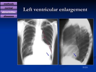 Left ventricular enlargement /231 methods normal abnormities diseases 