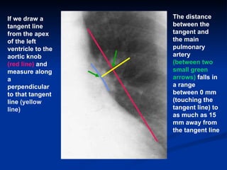 If we draw a tangent line from the apex of the left ventricle to the aortic knob  (red line)  and measure along a perpendi...