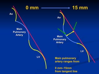 0 mm Main Pulmonary Artery Ao 15 mm Main Pulmonary Artery Ao LV LV Main pulmonary  artery ranges from  0 mm–15mm  from tan...