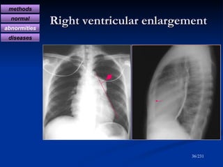 Right ventricular enlargement /231 methods normal abnormities diseases 