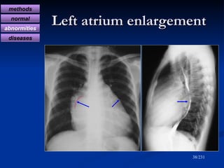Left atrium enlargement /231 methods normal abnormities diseases 