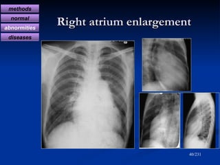 Right atrium enlargement /231 methods normal abnormities diseases 
