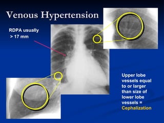Venous Hypertension  RDPA usually  > 17 mm   Upper lobe vessels equal to or larger than size of lower lobe vessels =  Ceph...
