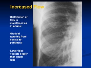 Increased Flow   Distribution of flow is maintained as in normal  Lower lobe vessels bigger than upper lobe Gradual taperi...