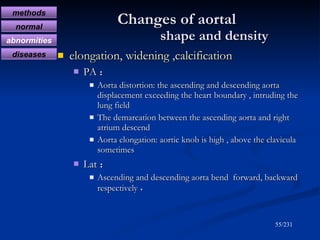 Changes of aortal     shape and density <ul><li>elongation, widening   ,calcification </li></ul><ul><ul><li>PA ： </li></ul...