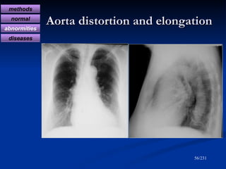 Aorta distortion and elongation /231 methods normal abnormities diseases 