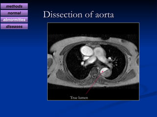 Dissection of aorta True lumen methods normal abnormities diseases 