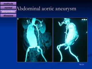 Abdominal aortic aneurysm /231 methods normal abnormities diseases 