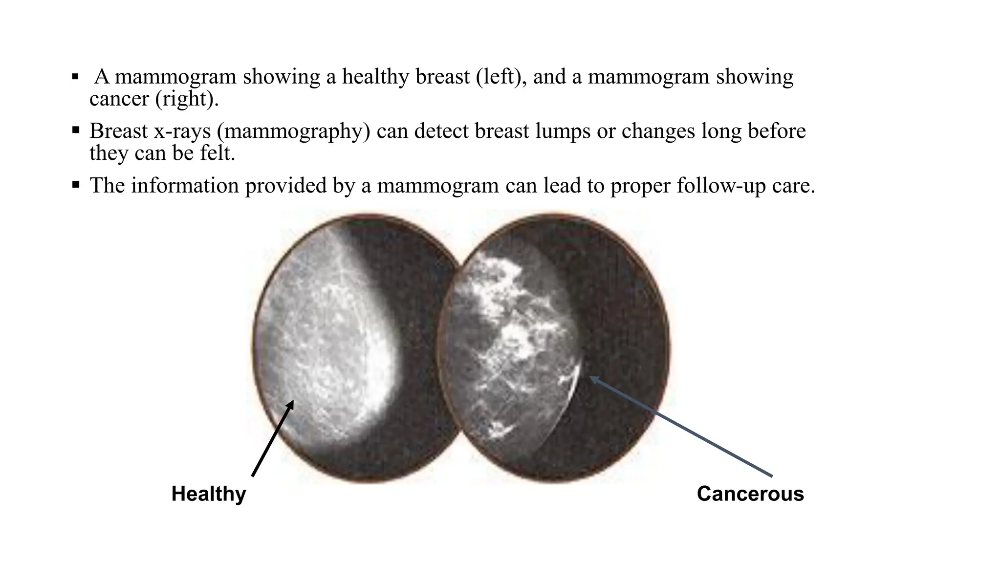 ▪ A mammogram showing a healthy breast (left), and a mammogram showing
cancer (right).
▪ Breast x-rays (mammography) can detect breast lumps or changes long before
they can be felt.
▪ The information provided by a mammogram can lead to proper follow-up care.
Healthy Cancerous
 