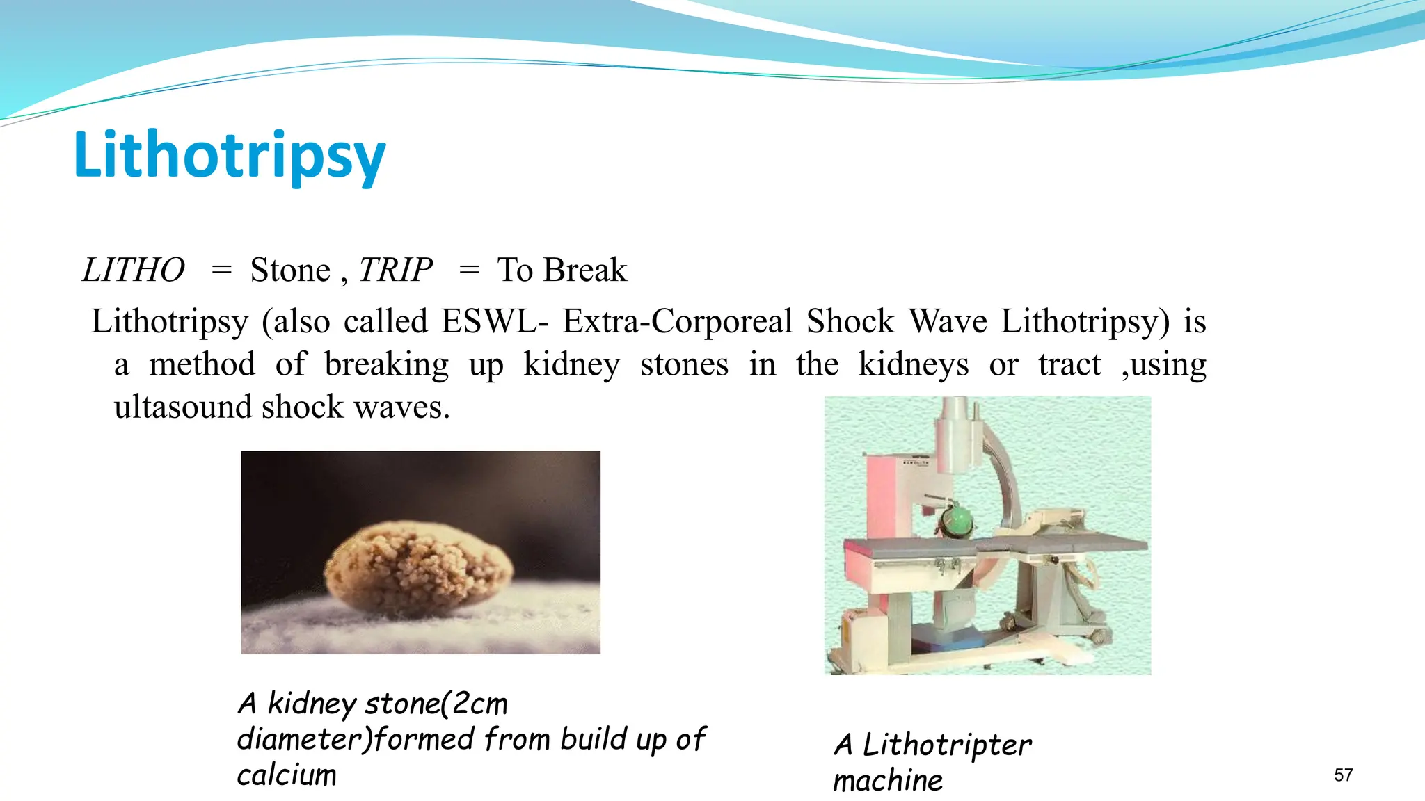 57
Lithotripsy
LITHO = Stone , TRIP = To Break
Lithotripsy (also called ESWL- Extra-Corporeal Shock Wave Lithotripsy) is
a method of breaking up kidney stones in the kidneys or tract ,using
ultasound shock waves.
A kidney stone(2cm
diameter)formed from build up of
calcium
A Lithotripter
machine
 
