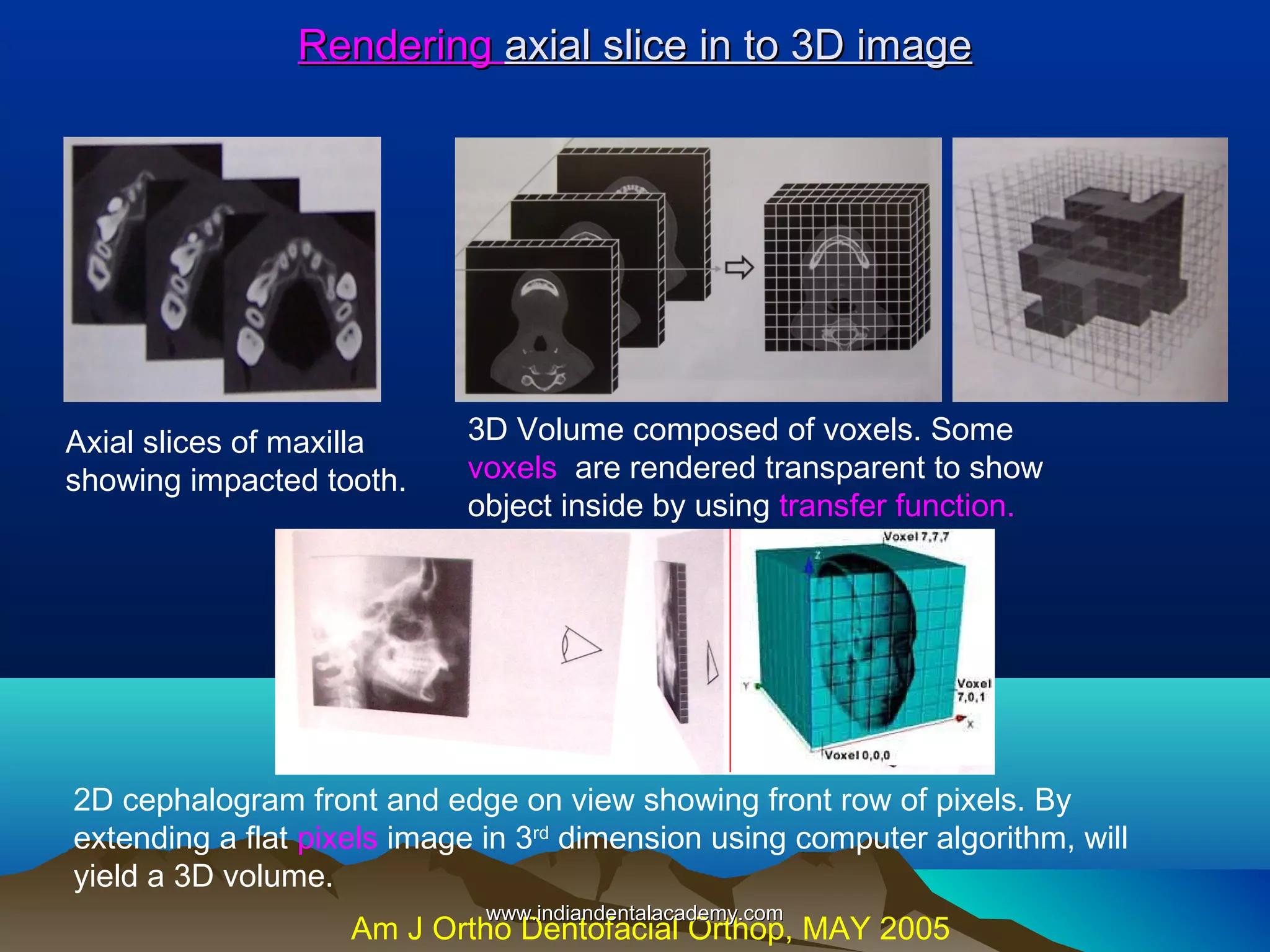 Rendering axial slice in to 3D image

Axial slices of maxilla
showing impacted tooth.

3D Volume composed of voxels. Some
voxels are rendered transparent to show
object inside by using transfer function.

2D cephalogram front and edge on view showing front row of pixels. By
extending a flat pixels image in 3rd dimension using computer algorithm, will
yield a 3D volume.
www.indiandentalacademy.com

Am J Ortho Dentofacial Orthop, MAY 2005

 