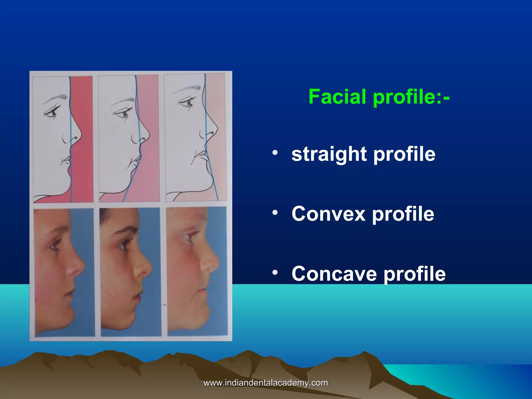 Facial profile:• straight profile
• Convex profile
• Concave profile

www.indiandentalacademy.com

 