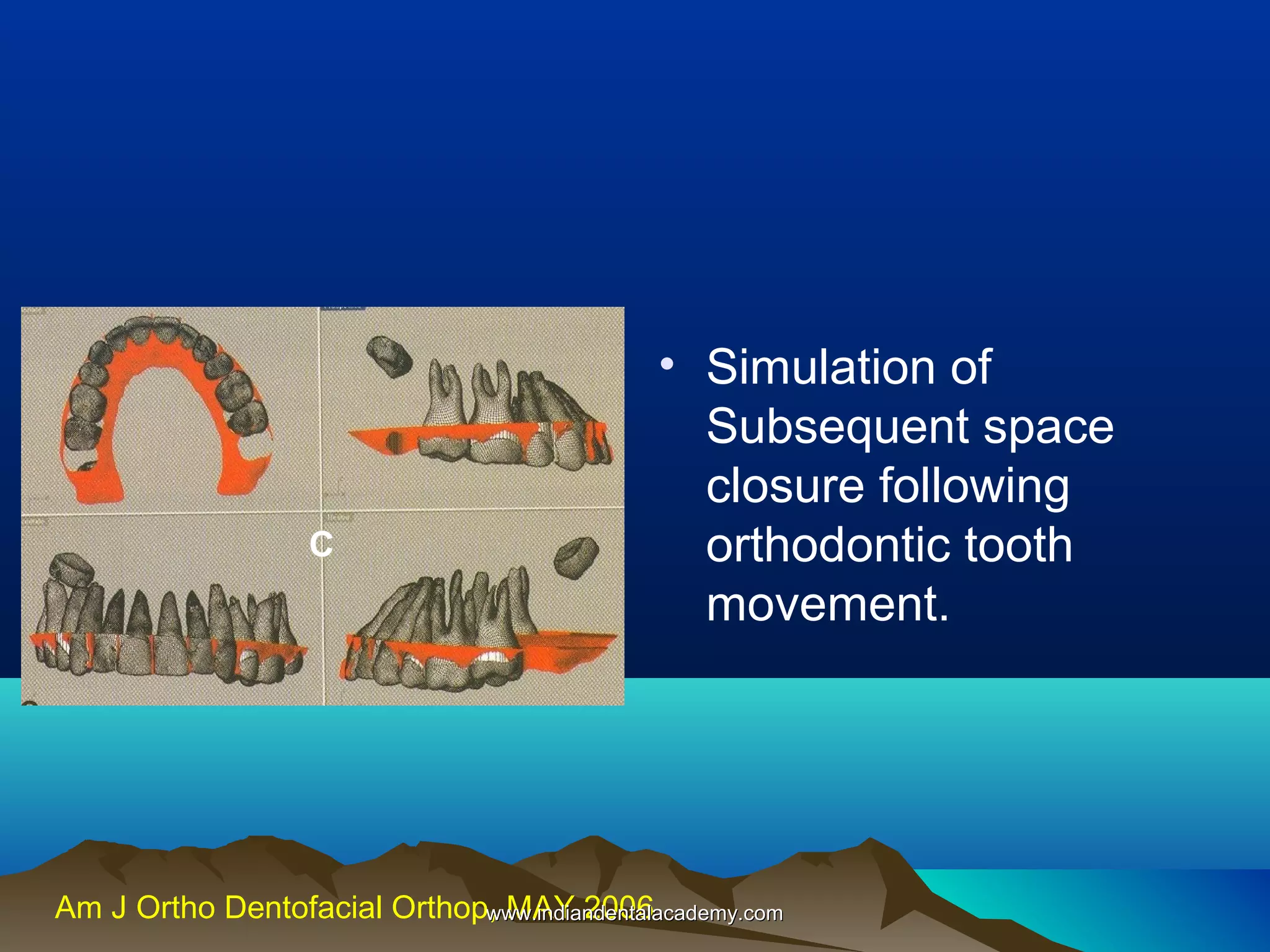 C

• Simulation of
Subsequent space
closure following
orthodontic tooth
movement.

Am J Ortho Dentofacial Orthop, MAY 2006
www.indiandentalacademy.com

 