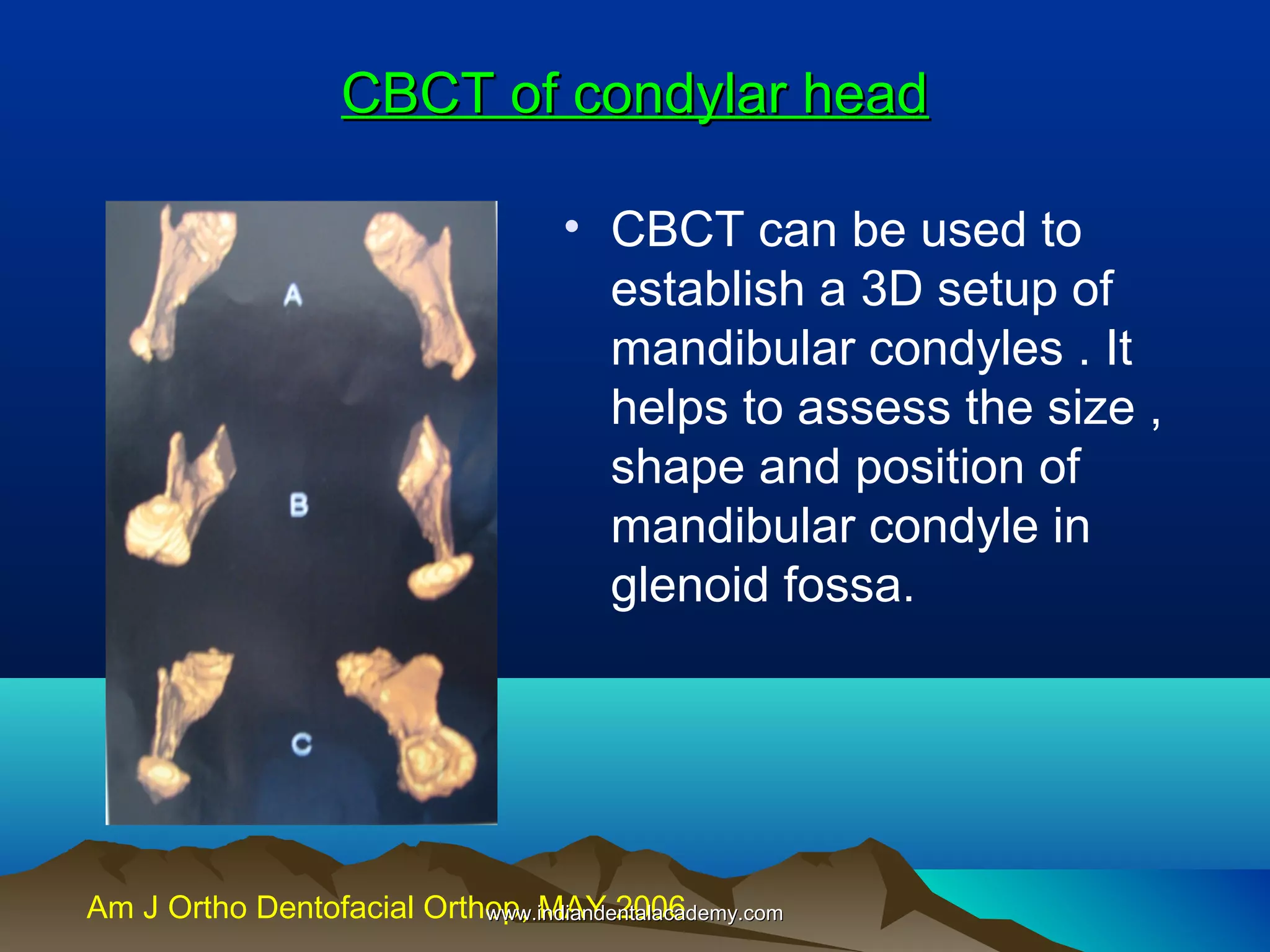 CBCT of condylar head
• CBCT can be used to
establish a 3D setup of
mandibular condyles . It
helps to assess the size ,
shape and position of
mandibular condyle in
glenoid fossa.

Am J Ortho Dentofacial Orthop, MAY 2006
www.indiandentalacademy.com

 