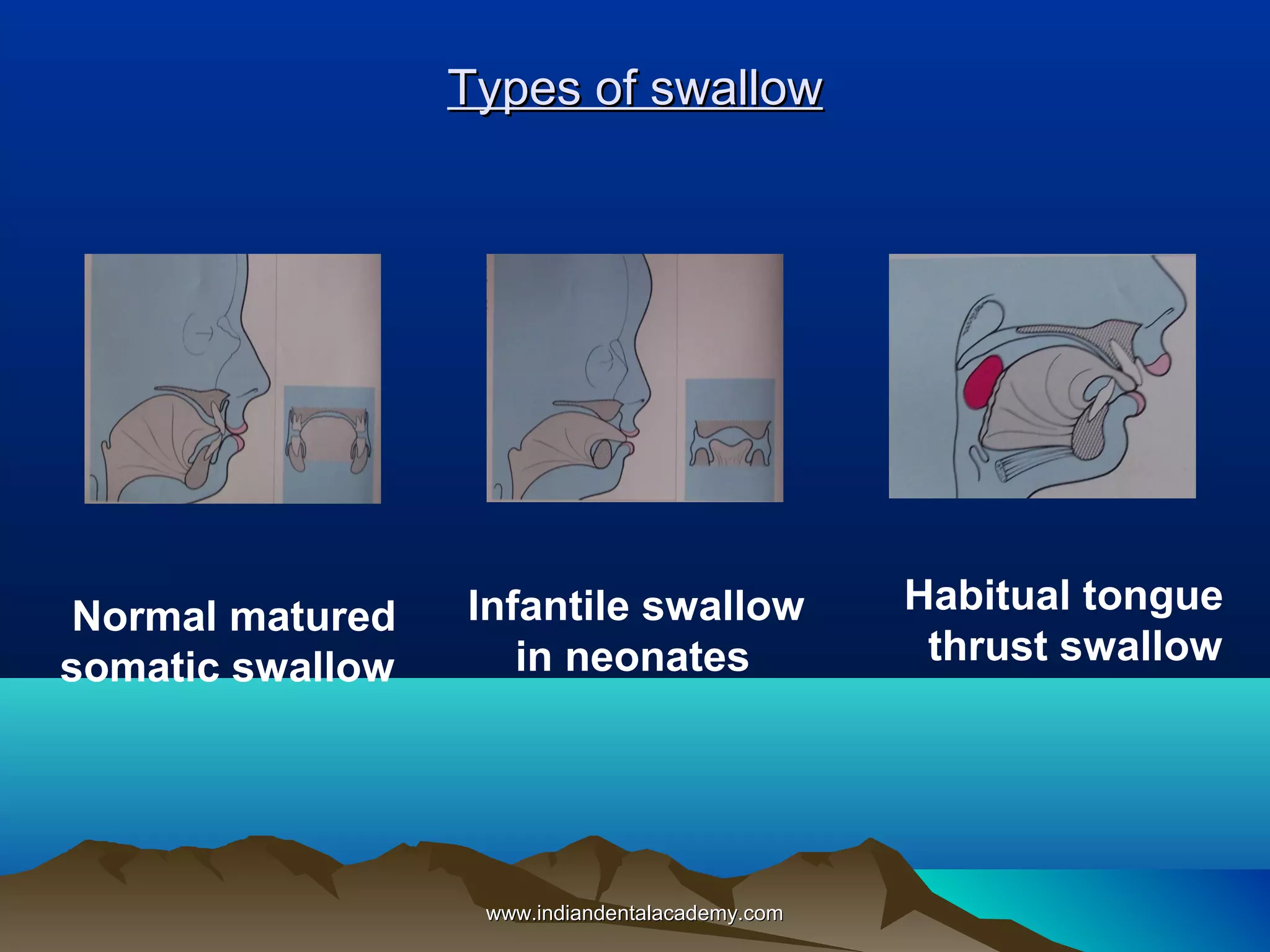 Types of swallow

Normal matured
somatic swallow

Infantile swallow
in neonates

www.indiandentalacademy.com

Habitual tongue
thrust swallow

 