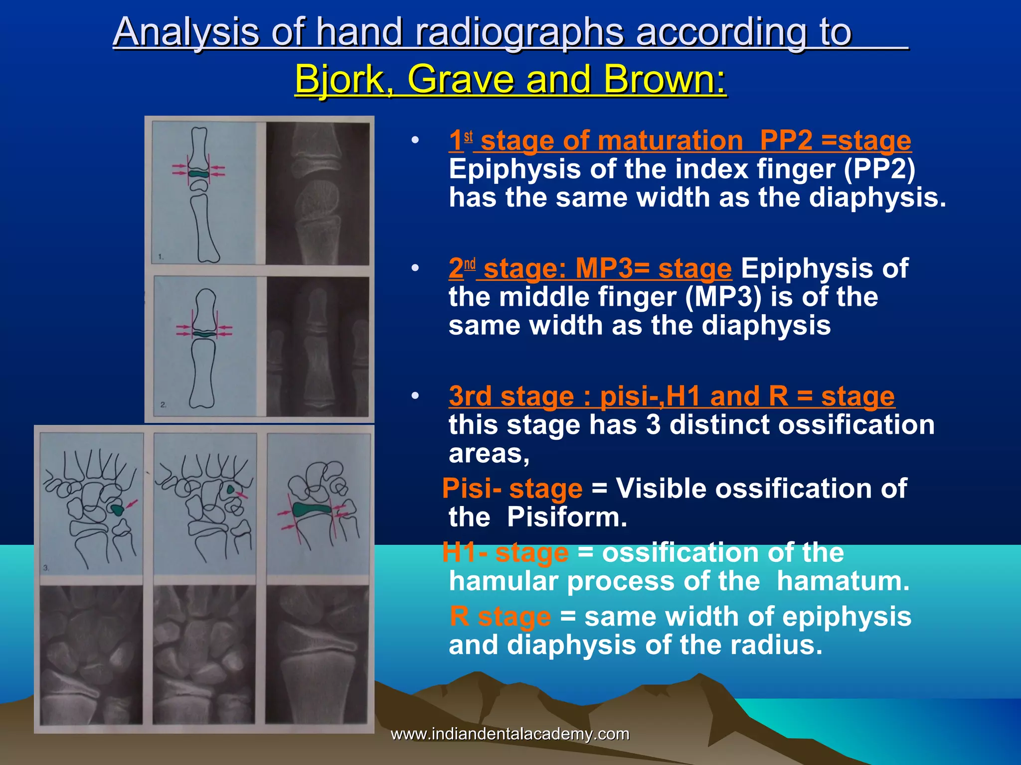 Analysis of hand radiographs according to
Bjork, Grave and Brown:
•

1st stage of maturation PP2 =stage
Epiphysis of the index finger (PP2)
has the same width as the diaphysis.

•

2nd stage: MP3= stage Epiphysis of
the middle finger (MP3) is of the
same width as the diaphysis

•

3rd stage : pisi-,H1 and R = stage
this stage has 3 distinct ossification
areas,
Pisi- stage = Visible ossification of
the Pisiform.
H1- stage = ossification of the
hamular process of the hamatum.
R stage = same width of epiphysis
and diaphysis of the radius.

www.indiandentalacademy.com

 