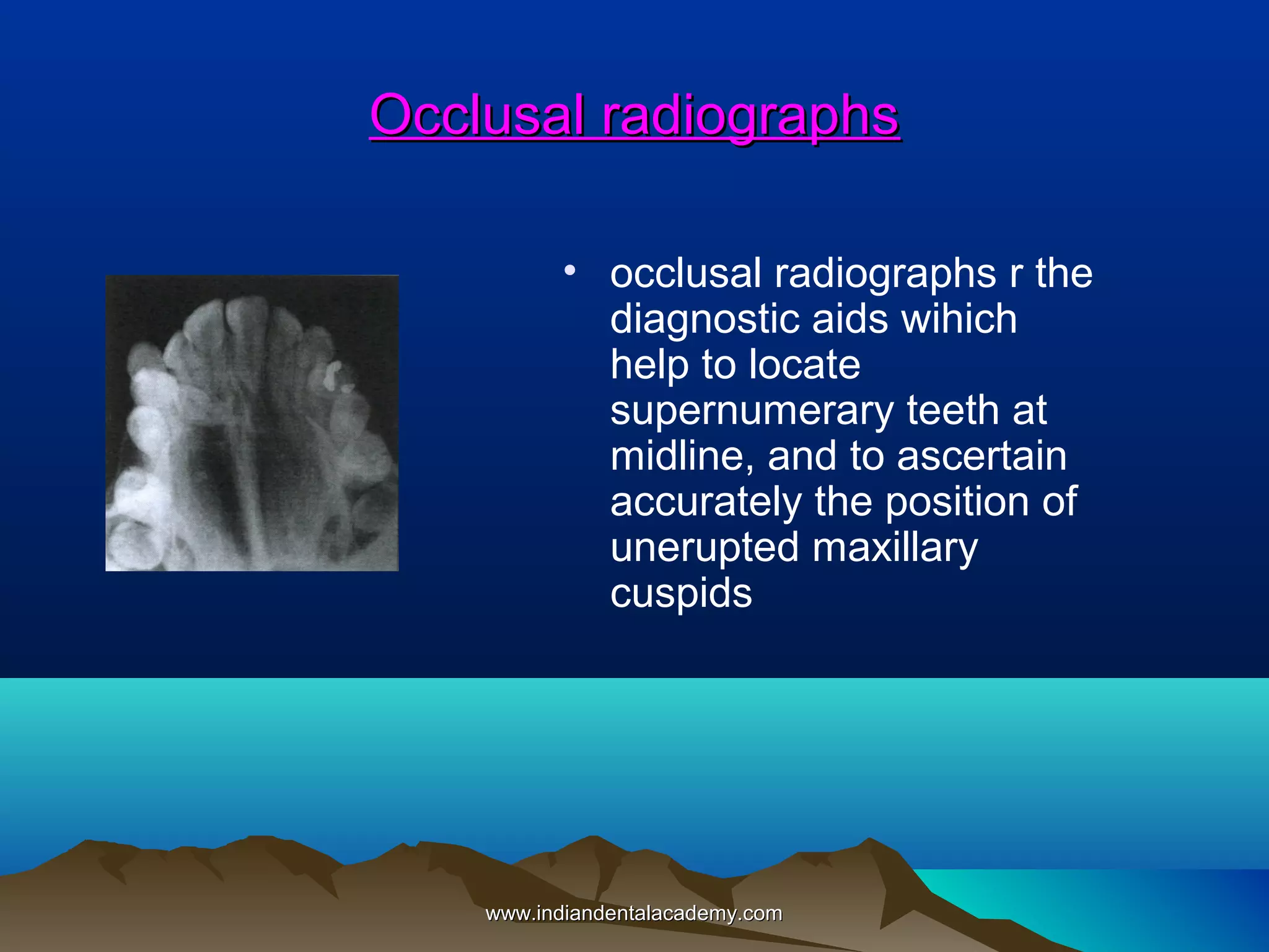 Occlusal radiographs
• occlusal radiographs r the
diagnostic aids wihich
help to locate
supernumerary teeth at
midline, and to ascertain
accurately the position of
unerupted maxillary
cuspids

www.indiandentalacademy.com

 