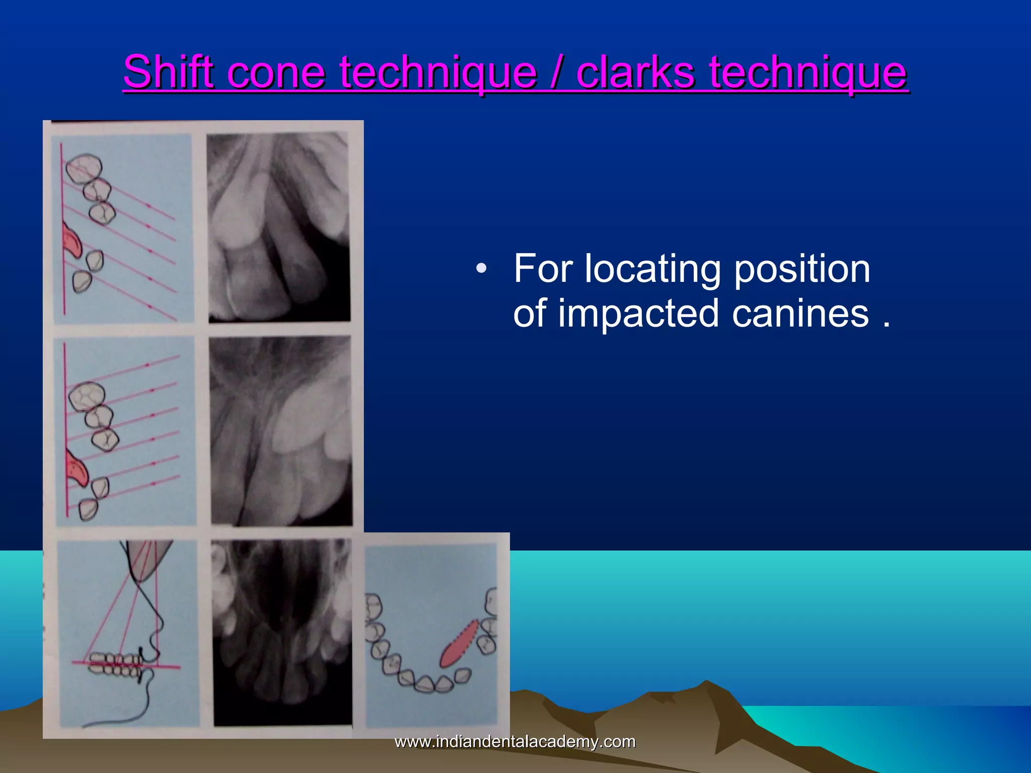 Shift cone technique / clarks technique

• For locating position
of impacted canines .

www.indiandentalacademy.com

 