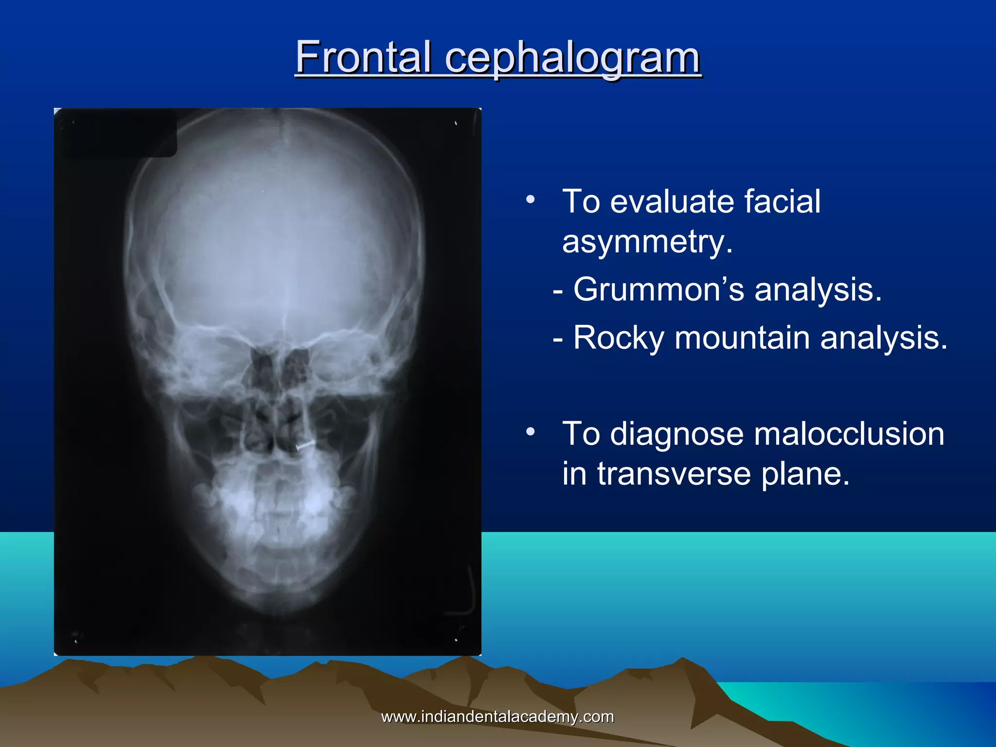 Frontal cephalogram
• To evaluate facial
asymmetry.
- Grummon’s analysis.
- Rocky mountain analysis.
• To diagnose malocclusion
in transverse plane.

www.indiandentalacademy.com

 