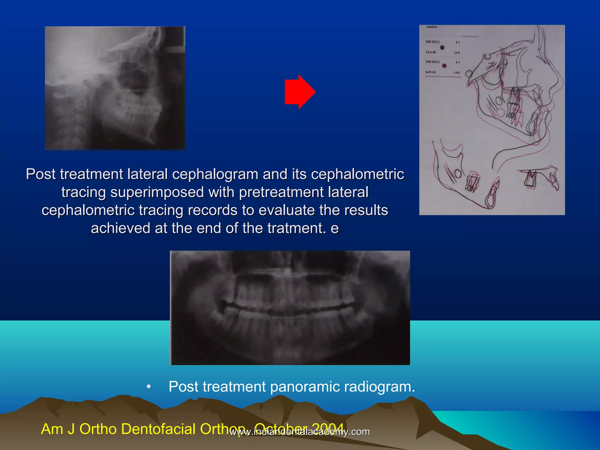 Post treatment lateral cephalogram and its cephalometric
tracing superimposed with pretreatment lateral
cephalometric tracing records to evaluate the results
achieved at the end of the tratment. e

•

Post treatment panoramic radiogram.

Am J Ortho Dentofacial Orthop, October 2004
www.indiandentalacademy.com

 