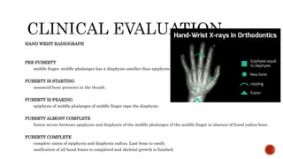 HAND WRIST RADIOGRAPH
PRE-PUBERTY
middle finger, middle phalanges has a diaphysis smaller than epiphysis.
PUBERTY IS STARTING
sesamoid bone presents in the thumb.
PUBERTY IS PEAKING
epiphysis of middle phalanges of middle finger caps the diaphysis
PUBERTY ALMOST COMPLETE
fusion occurs between epiphysis and diaphysis of the middle phalanges of the middle finger in absence of fused radius bone.
PUBERTY COMPLETE
complete union of epiphysis and diaphysis radius. Last bone to ossify.
ossification of all hand bones is completed and skeletal growth is finished.
 
