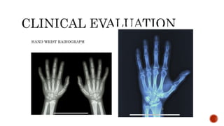 HAND WRIST RADIOGRAPH
 