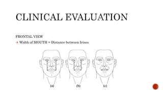 FRONTAL VIEW
 Width of MOUTH = Distance between Irises
 