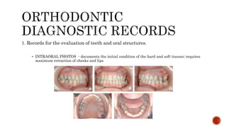 1. Records for the evaluation of teeth and oral structures.
 INTRAORAL PHOTOS - documents the initial condition of the hard and soft tissues; requires
maximum retraction of cheeks and lips
 