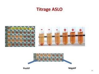 Titrage ASLO
88
Positif Négatif
 