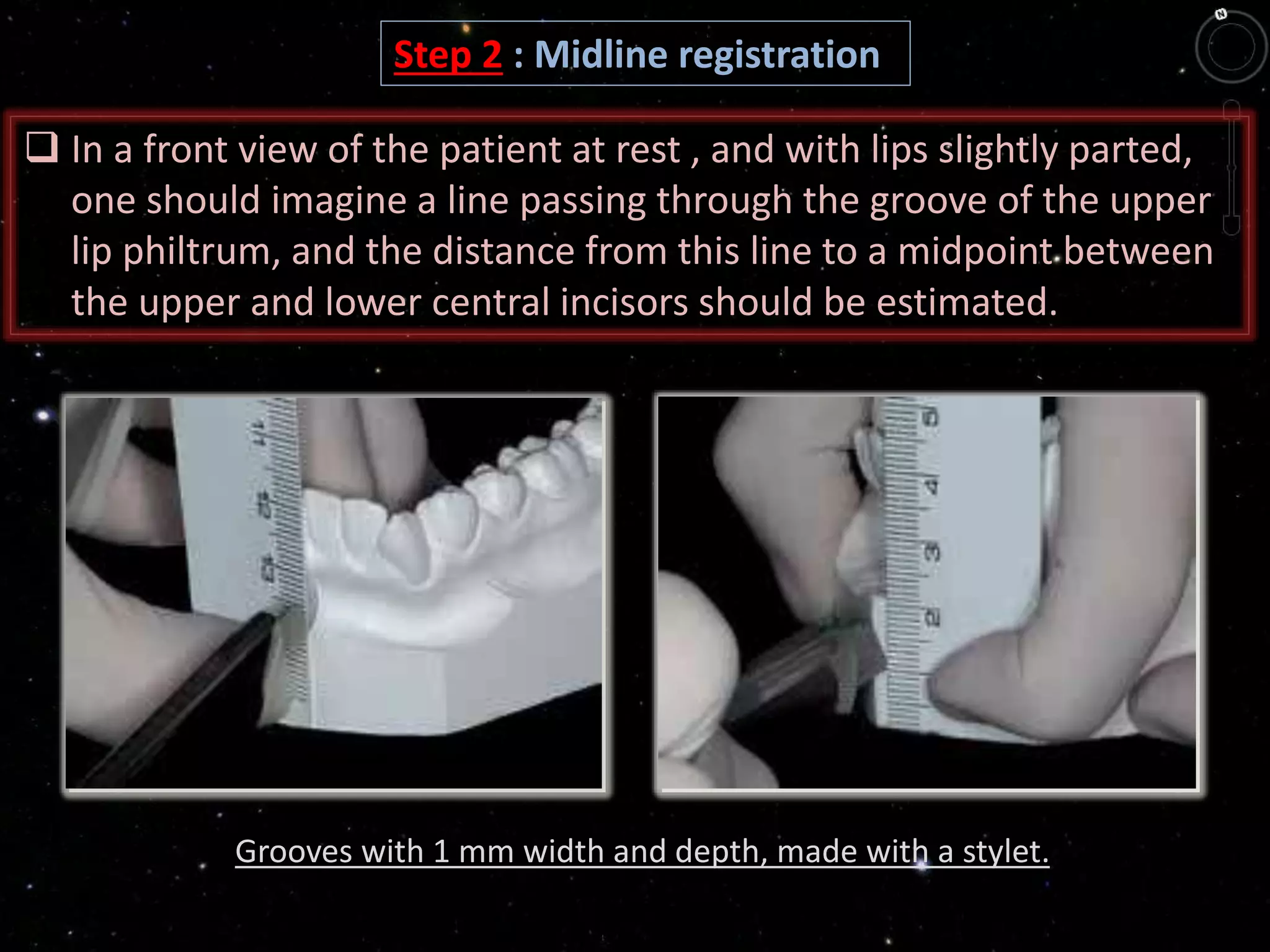 Step 2 : Midline registration
Grooves with 1 mm width and depth, made with a stylet.
 In a front view of the patient at rest , and with lips slightly parted,
one should imagine a line passing through the groove of the upper
lip philtrum, and the distance from this line to a midpoint between
the upper and lower central incisors should be estimated.
 