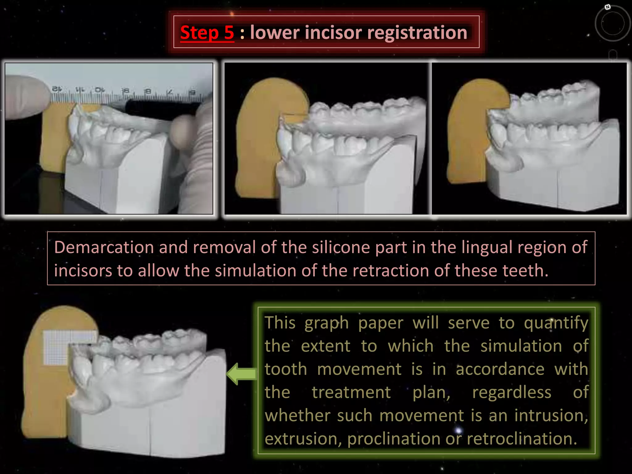 Demarcation and removal of the silicone part in the lingual region of
incisors to allow the simulation of the retraction of these teeth.
Step 5 : lower incisor registration
This graph paper will serve to quantify
the extent to which the simulation of
tooth movement is in accordance with
the treatment plan, regardless of
whether such movement is an intrusion,
extrusion, proclination or retroclination.
 