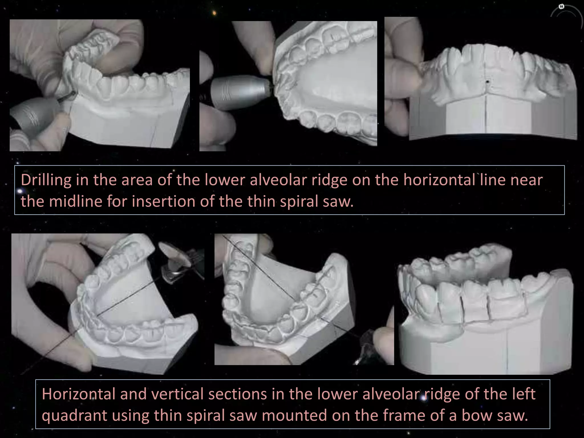 Drilling in the area of the lower alveolar ridge on the horizontal line near
the midline for insertion of the thin spiral saw.
Horizontal and vertical sections in the lower alveolar ridge of the left
quadrant using thin spiral saw mounted on the frame of a bow saw.
 