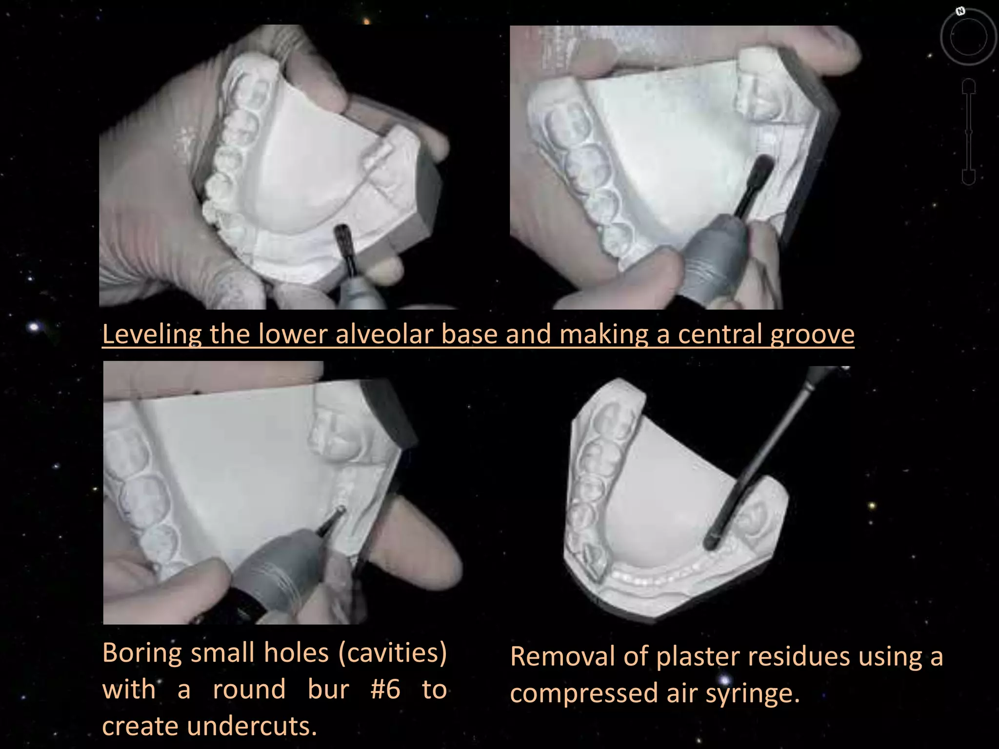 Leveling the lower alveolar base and making a central groove
Boring small holes (cavities)
with a round bur #6 to
create undercuts.
Removal of plaster residues using a
compressed air syringe.
 