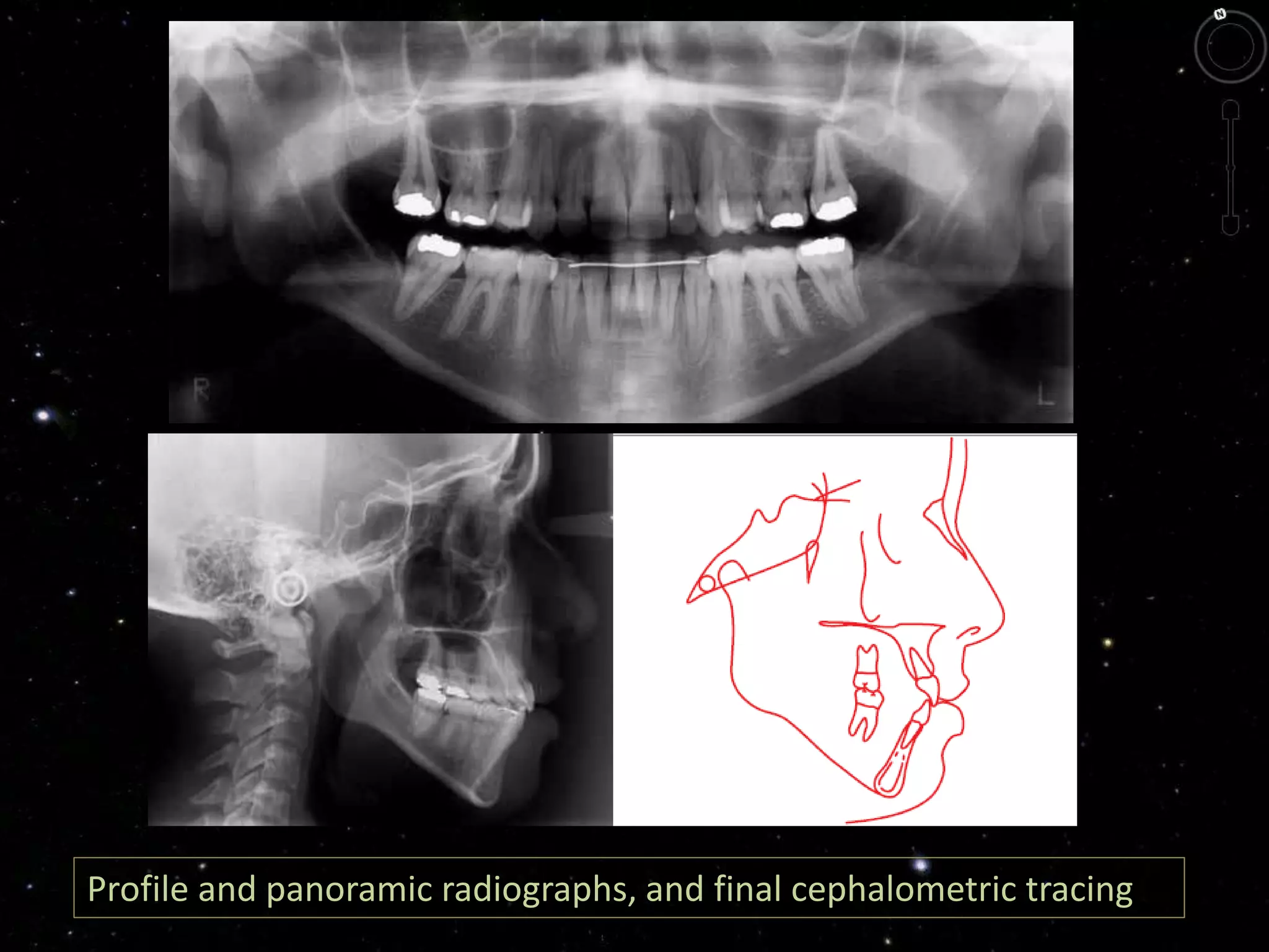 Profile and panoramic radiographs, and final cephalometric tracing
 