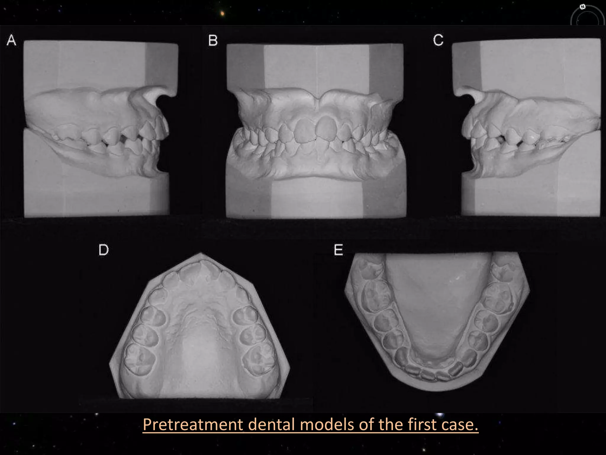 Pretreatment dental models of the first case.
 