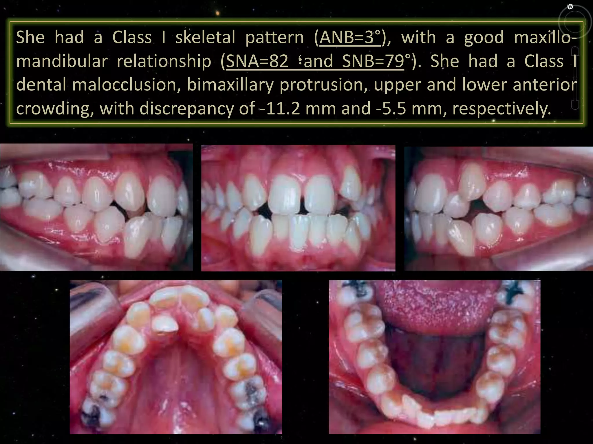 She had a Class I skeletal pattern (ANB=3°), with a good maxillo-
mandibular relationship (SNA=82 ‫؛‬and SNB=79°). She had a Class I
dental malocclusion, bimaxillary protrusion, upper and lower anterior
crowding, with discrepancy of -11.2 mm and -5.5 mm, respectively.
 