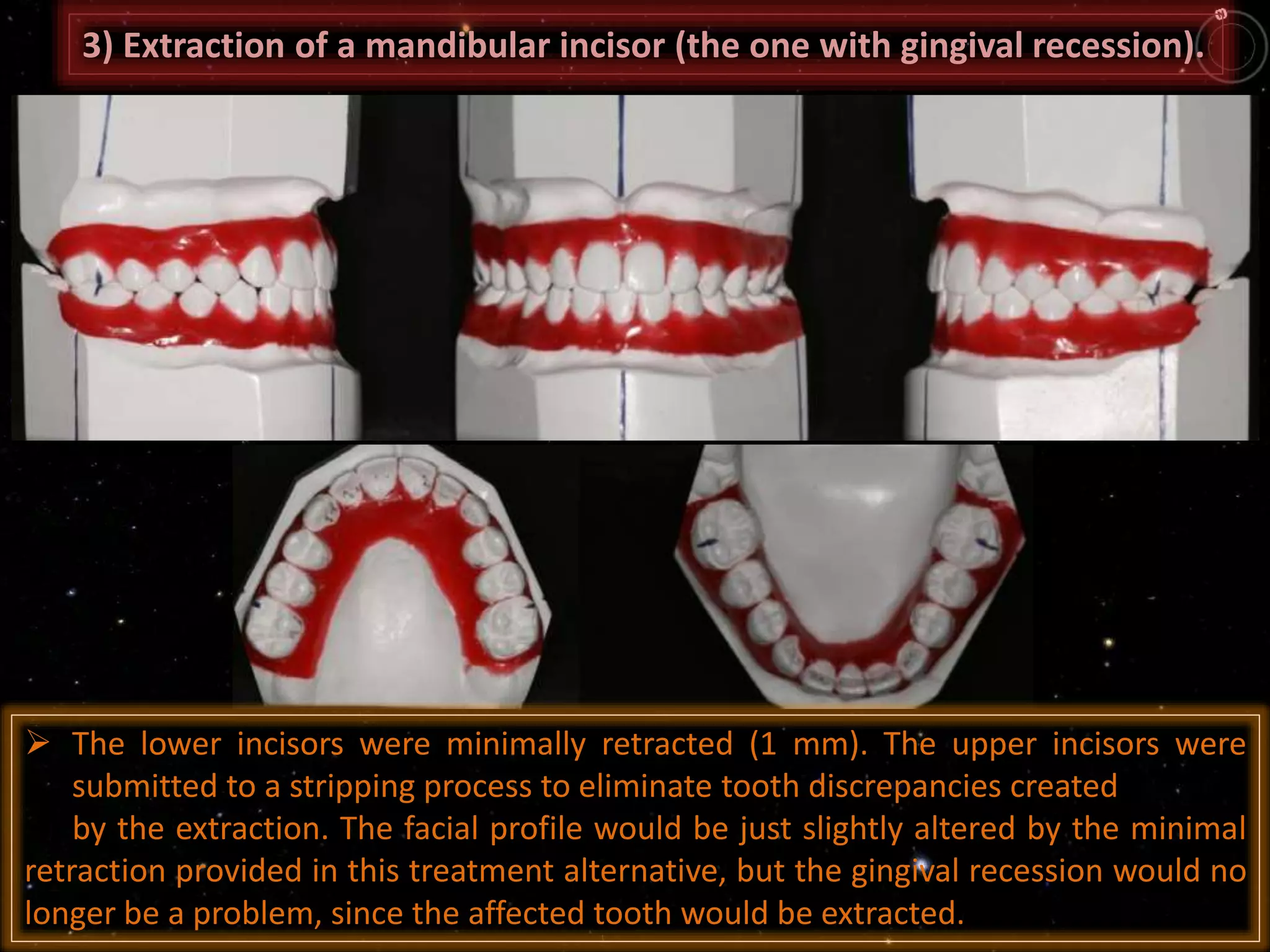 3) Extraction of a mandibular incisor (the one with gingival recession).
 The lower incisors were minimally retracted (1 mm). The upper incisors were
submitted to a stripping process to eliminate tooth discrepancies created
by the extraction. The facial profile would be just slightly altered by the minimal
retraction provided in this treatment alternative, but the gingival recession would no
longer be a problem, since the affected tooth would be extracted.
 