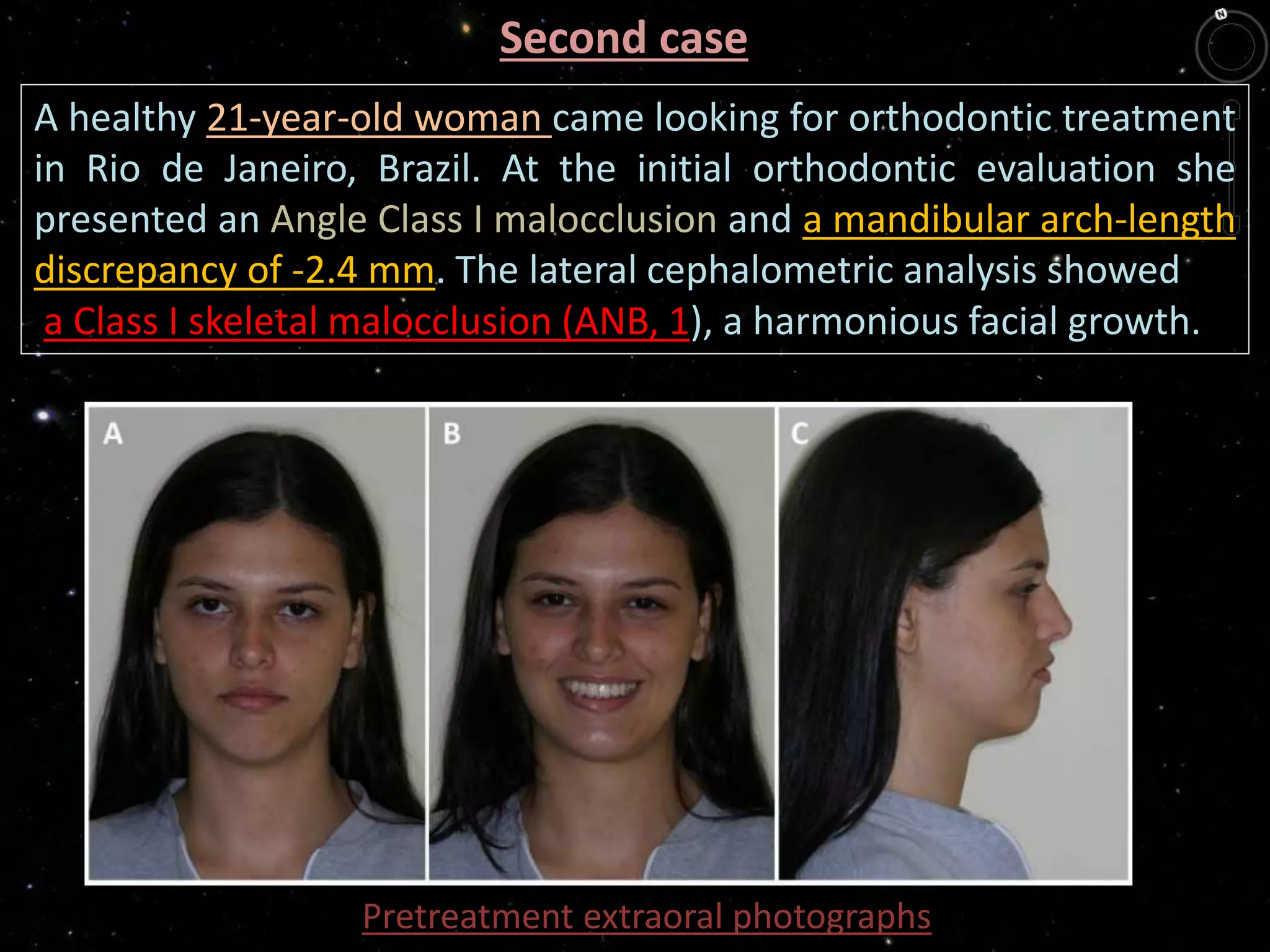 Second case
A healthy 21-year-old woman came looking for orthodontic treatment
in Rio de Janeiro, Brazil. At the initial orthodontic evaluation she
presented an Angle Class I malocclusion and a mandibular arch-length
discrepancy of -2.4 mm. The lateral cephalometric analysis showed
a Class I skeletal malocclusion (ANB, 1), a harmonious facial growth.
Pretreatment extraoral photographs
 
