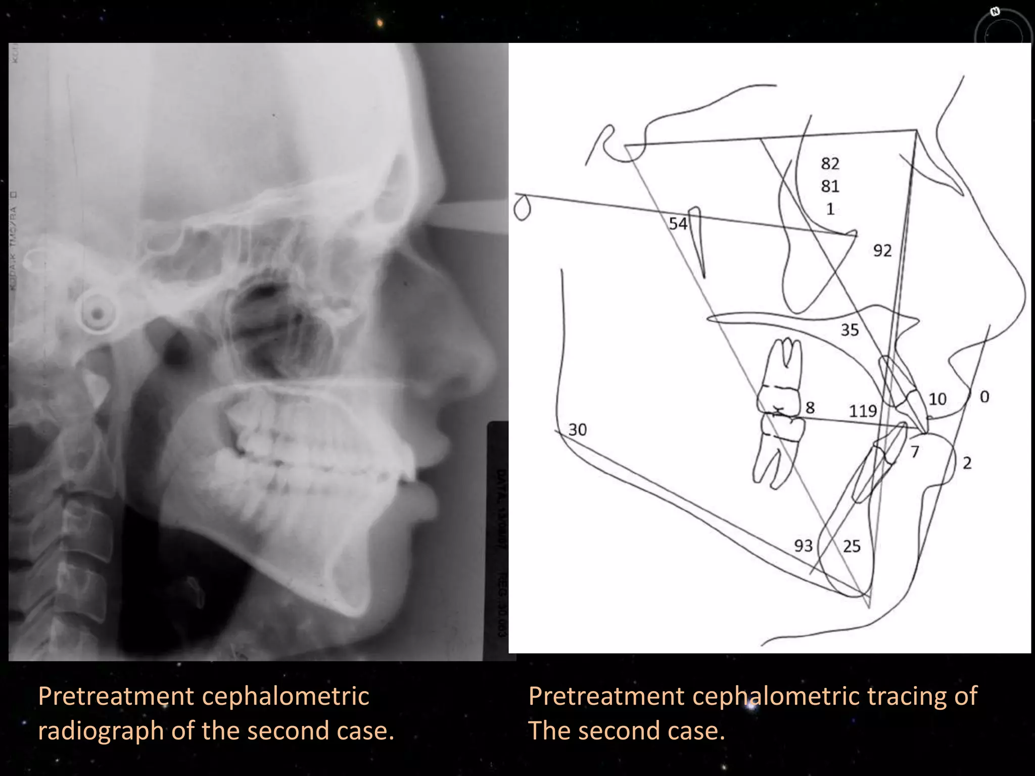 Pretreatment cephalometric
radiograph of the second case.
Pretreatment cephalometric tracing of
The second case.
 