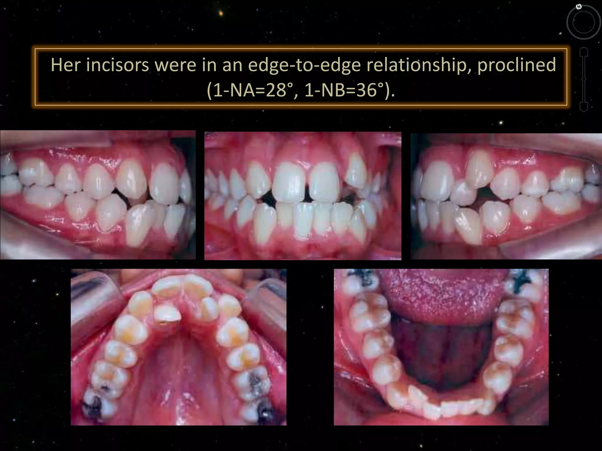 Her incisors were in an edge-to-edge relationship, proclined
(1-NA=28°, 1-NB=36°).
 