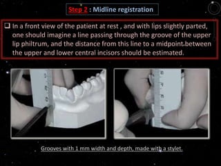 Step 2 : Midline registration
Grooves with 1 mm width and depth, made with a stylet.
 In a front view of the patient at rest , and with lips slightly parted,
one should imagine a line passing through the groove of the upper
lip philtrum, and the distance from this line to a midpoint between
the upper and lower central incisors should be estimated.
 