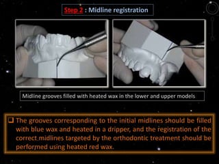 Midline grooves filled with heated wax in the lower and upper models
 The grooves corresponding to the initial midlines should be filled
with blue wax and heated in a dripper, and the registration of the
correct midlines targeted by the orthodontic treatment should be
performed using heated red wax.
Step 2 : Midline registration
 