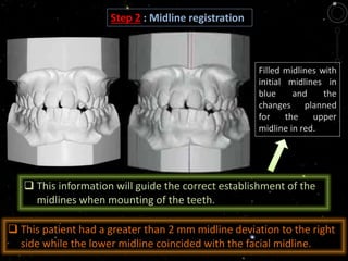 Filled midlines with
initial midlines in
blue and the
changes planned
for the upper
midline in red.
 This information will guide the correct establishment of the
midlines when mounting of the teeth.
Step 2 : Midline registration
 This patient had a greater than 2 mm midline deviation to the right
side while the lower midline coincided with the facial midline.
 