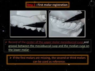 Step 3 : First molar registration
 Record of the center of the upper molar mesiobuccal cusp and
groove between the mesiobuccal cusp and the median cusp on
the lower molar .
 If the first molars are missing, the second or third molars
can be used as reference.
 