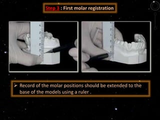  Record of the molar positions should be extended to the
base of the models using a ruler .
Step 3 : First molar registration
 