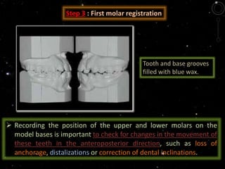 Tooth and base grooves
filled with blue wax.
Step 3 : First molar registration
 Recording the position of the upper and lower molars on the
model bases is important to check for changes in the movement of
these teeth in the anteroposterior direction, such as loss of
anchorage, distalizations or correction of dental inclinations.
 